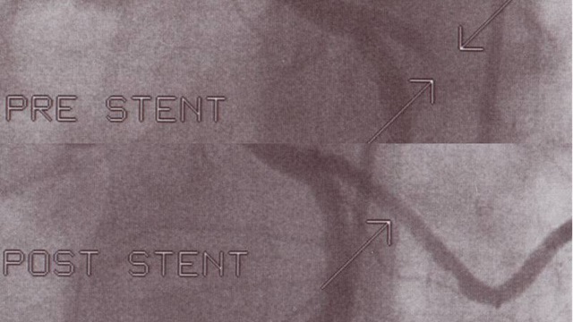 Pre and post stent